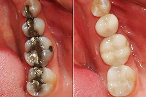 konservatif-dis-tedavileri